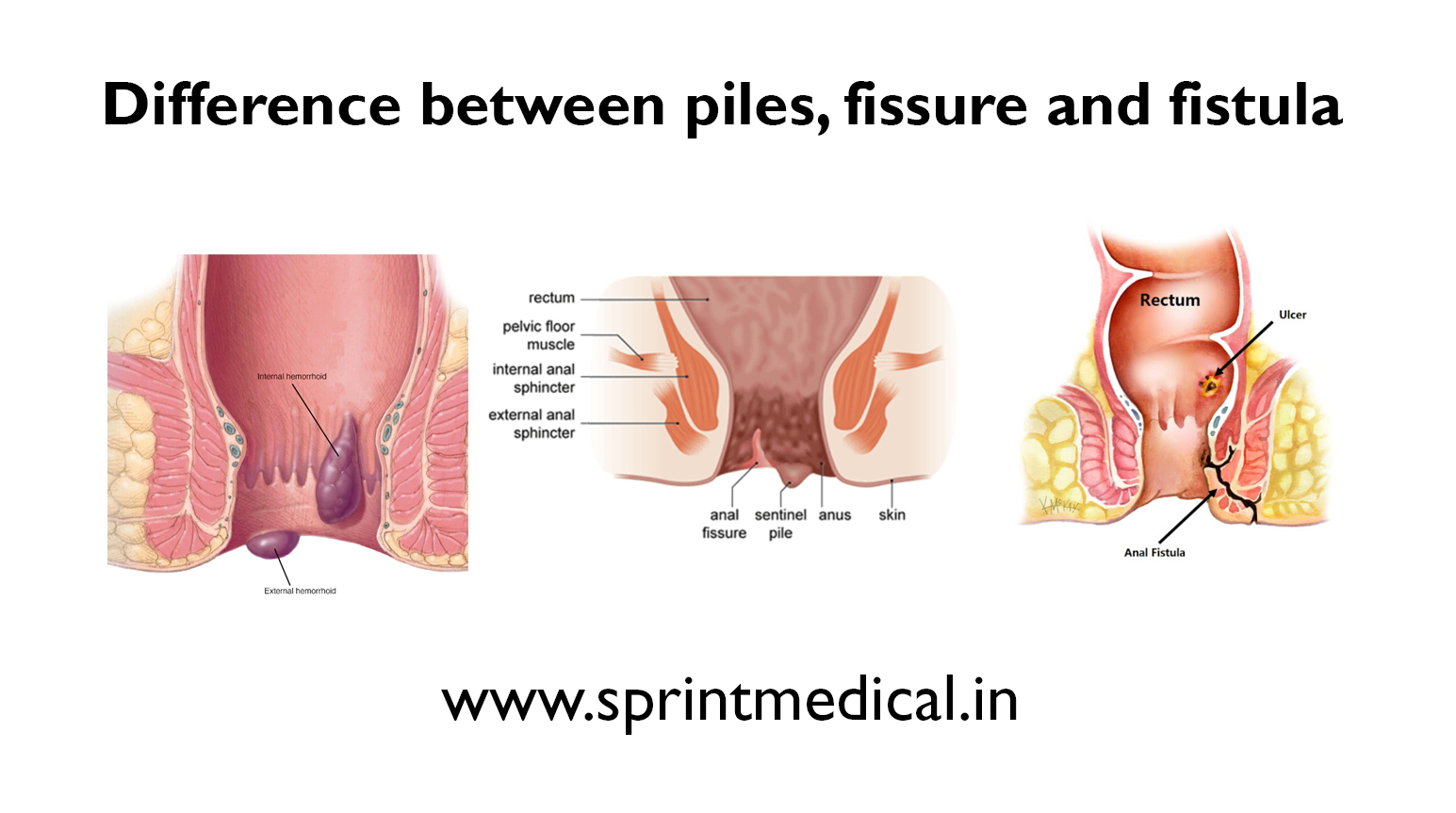Difference between Piles and Fissure
