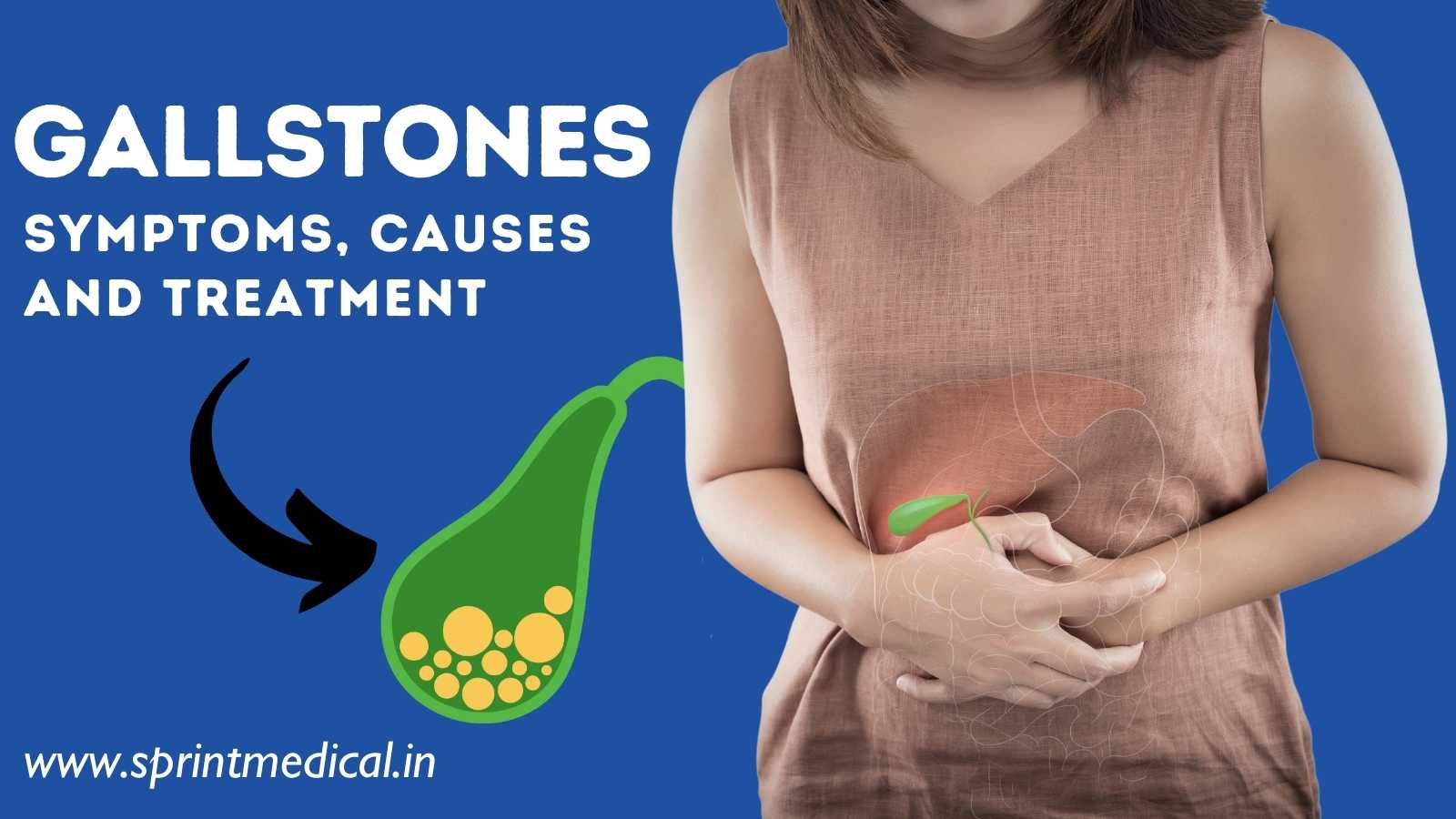 Gallstones (Cholelithiasis): Symptoms, Causes and Treatment | Sprint ...