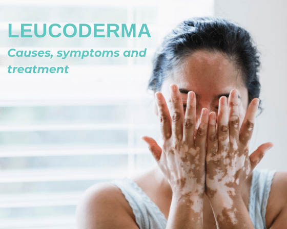 Leucoderma Causes, symptoms and treatment