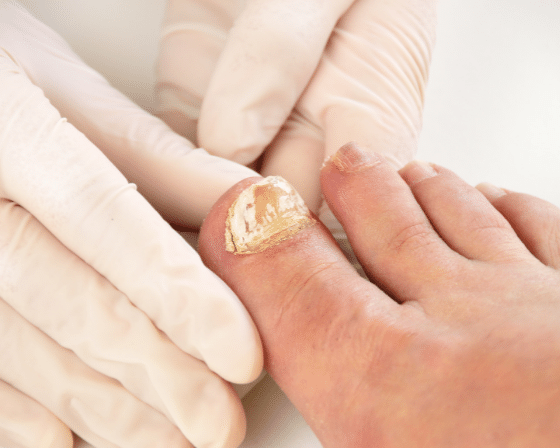 5 Possibilities Why Your Big Toe Hurts