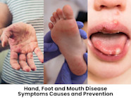 Hand Foot Mouth Disease Rash Cal Description Infoupdate