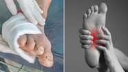 Diabetic Neuropathy Symptoms Causes Risk Factors And Prevention 