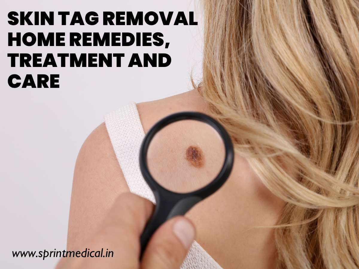 Skin Tag Removal Home Remedies, Treatment and Care