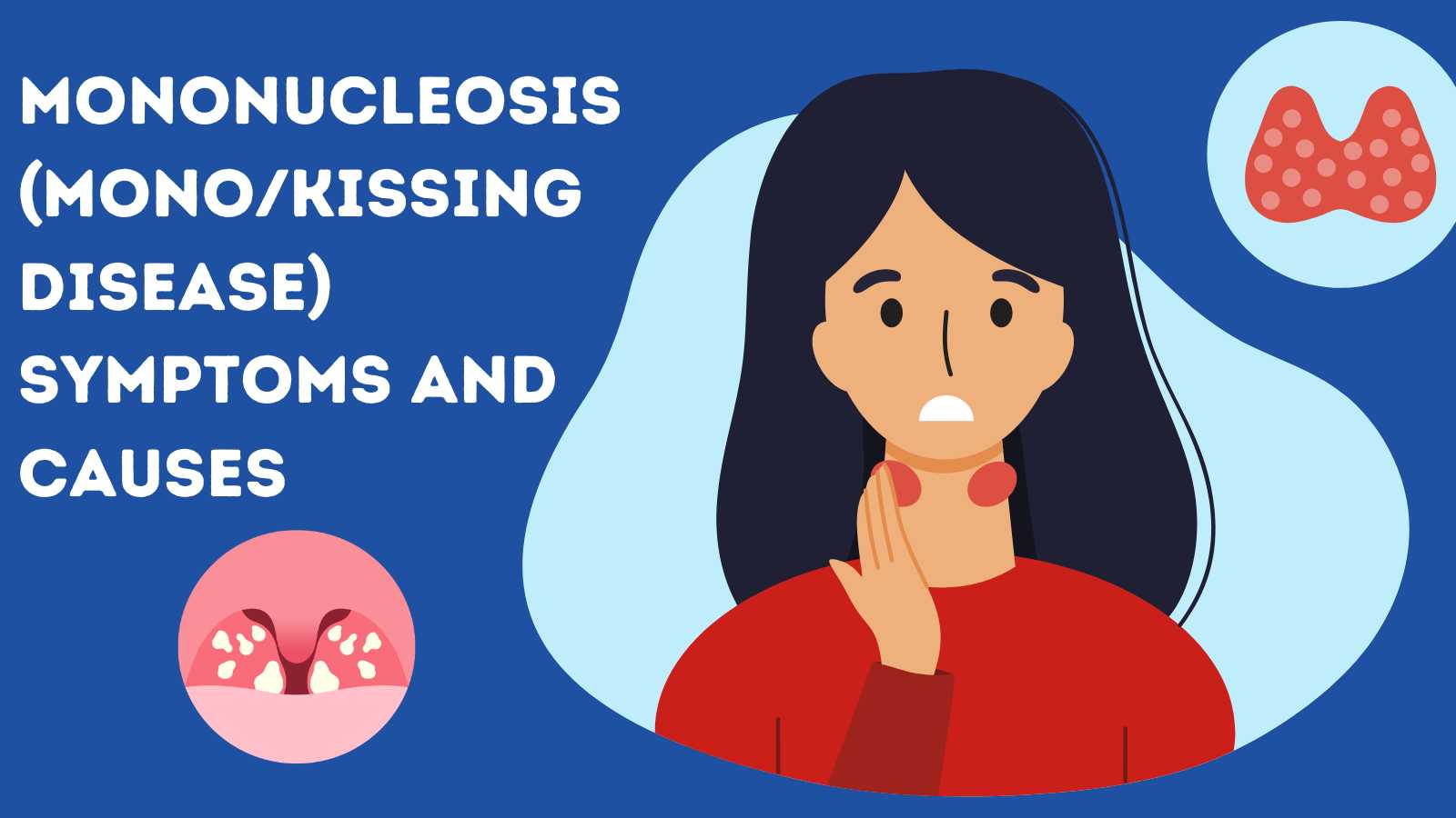 Mononucleosis (MonoKissing Disease) Symptoms and Causes