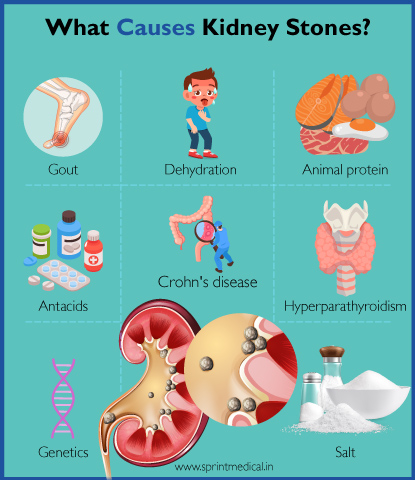 Why People Get Kidney Stones