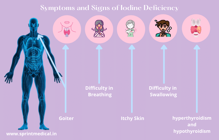 iodine deficiency symptoms