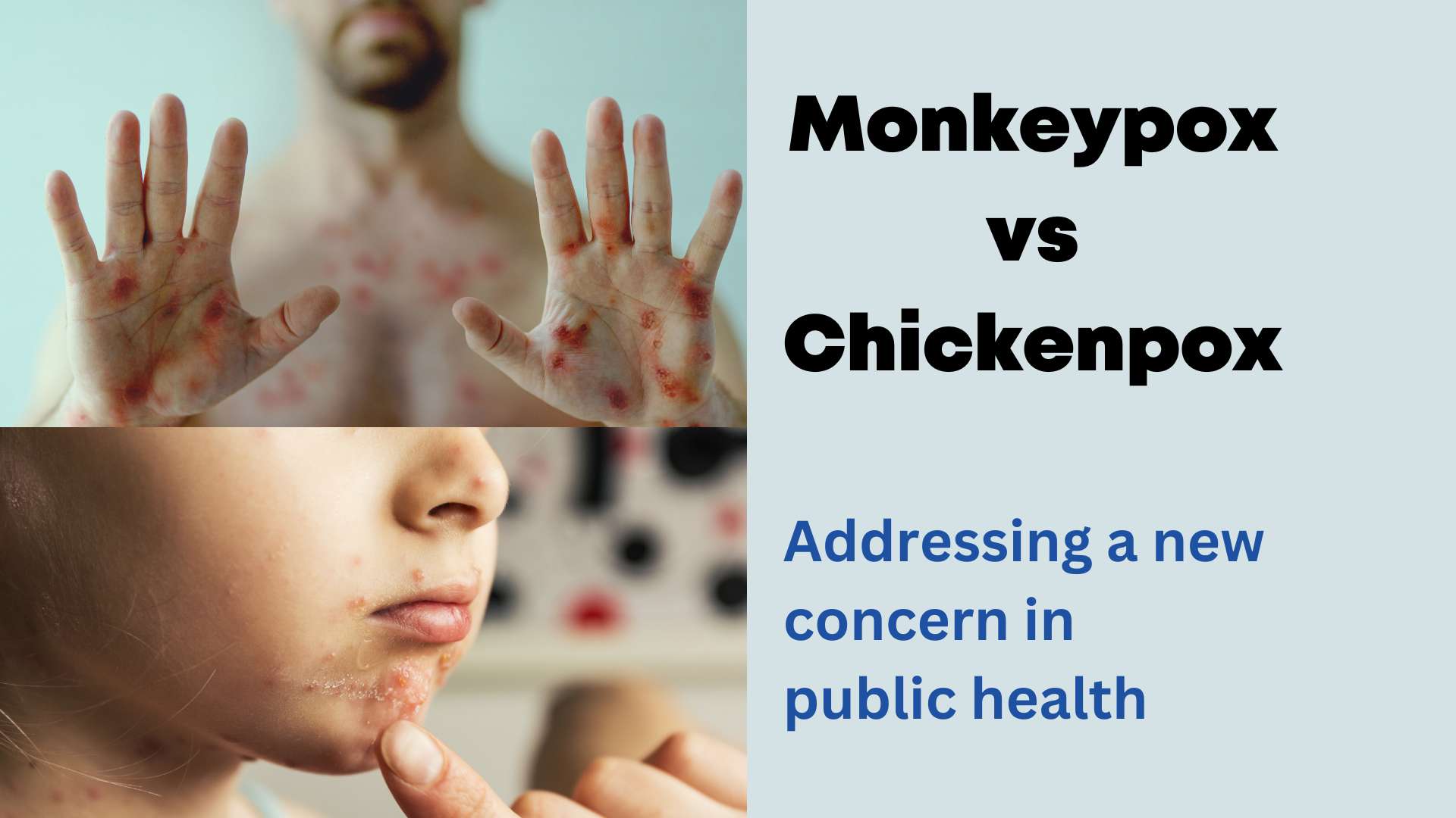 Monkeypox vs Chickenpox Addressing a new concern in public health