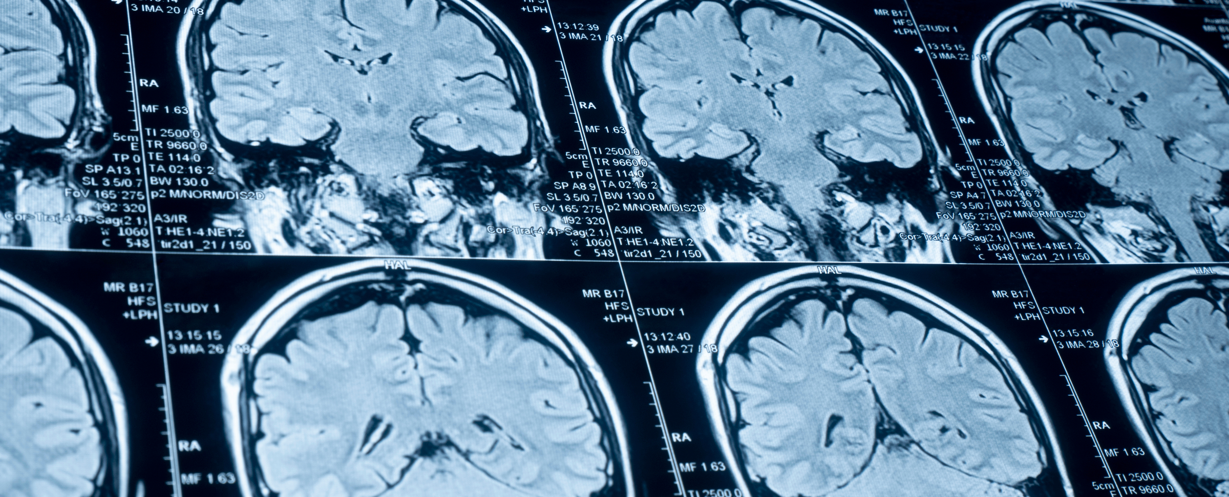 MRI_brain_scans-1570844354.jpg