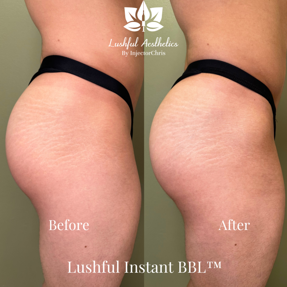 hyperdilute Radiesse before and after, Radiesse filler for buttocks augmentation