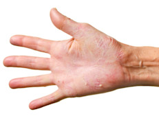 Unas 125 millones de personas en todo el mundo tienen psoriasis. Es una enfermedad de la piel que causa descamación e inflamación. Se produce porque la renovación celular, que tarda cerca de un mes, en personas con psoriasis ocurre en unos pocos días, lo que provoca que las células nuevas suban demasiado rápido y se acumulen en la superficie.