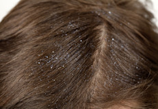 La piel seca o irritada puede conducir a la descamación, lo que se traduce en muchos casos en la conocida caspa. Gracias a sus propiedades hidratantes, antibacterianas y antiinflamatorias, el aceite de jojoba puede disminuir las consecuencias de esta afección. Para ello, se recomienda agregar algunas gotas en tu champú, para luego aprovechar sus propiedades mientras masajeas el cuero cabelludo.