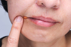 La queilitis angular (boqueras o perleche) son fisuras o grietas en las comisuras de los labios, muy dolorosas, que  te impiden comer o beber líquidos. Aparecen cubiertas por una membrana blanquecina o amarillenta. Se producen por infección micótica , bacteriana, déficit de vitaminas, anemia, mala alimentación, prótesis dentales inadecuadas, inmunodepresión o defensas bajas, acumulación de saliva en las comisuras labiales o estrés.