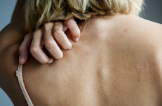 La psoriasis es un problema del sistema inmunológico, específicamente en el proceso de recambio celular. Normalmente, el crecimiento de las células cutáneas en la parte más profunda de la piel y su avance hacia la superficie demora un mes, pero en el caso de la psoriasis este proceso ocurre en cuestión de unos pocos días.