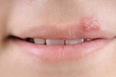 The herpes virus is a global public health problem. Infections caused by the two types of this virus last a lifetime. Throughout the globe, there are an estimated 3.7 billion people infected by herpes type 1 (HSV‑1) and 417 million people infected by herpes type 2 (HSV‑2). 
