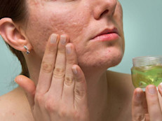 El aloe, tiene propiedades bacterianas y astringentes (reguladoras de la grasa) que lo hacen ideal para tratar el acné, toda vez que ayuda a limpiar la piel desde sus capas más profundas, lo que favorece la desobstrucción de poros y la eliminación de la suciedad que causa la aparición de impurezas. Aplica el gel de aloe en las zonas problemas unos 30 minutos antes de acostarte y deja durante toda la noche, lava la cara como de costumbre.