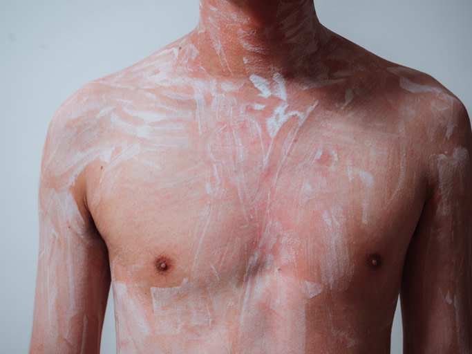 ¿Has pensado en que la picazón que tienes en el brazo o esa extraña tos que no se cura pueden ser síntomas de una infección por hongos? Ahora tal vez te estés preguntando qué debes hacer para cuidarte o cómo reconocer si te has enfermado por culpa de un hongo. Aquí te ayudaremos a dar con esas respuestas y más.