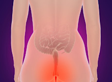 Aparece una masa suave que sobresale del ano (hemorroide prolapsada); pueden aparecer protuberancias molestas que surgen de las hemorroides externas, o presentarse repentinamente en el borde del ano una protuberancia dolorosa o bulto firme (hemorroide con trombosis) que puede sangrar o estar teñida de azul. El dolor intenso no es un síntoma típico, excepto si es hemorroide externa con trombosis.