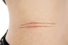 Por su acción antioxidante, la papaya sería ideal para tratar inflamaciones, supuraciones de pus, callos, verrugas, granos y otras enfermedades cutáneas. En Centroamérica, en los lugares donde no se encuentran hospitales ni farmacias, sus hojas se aplican en forma de compresas sobre las heridas infectadas para ayudar a que se limpie y cicatrice la piel.