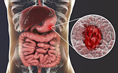 Gastric ulcers, which are most commonly caused by infection with the bacterium Helicobacter pylori, are usually very bothersome. Ulcers can cause a burning sensation similar to hunger pangs, as well as nausea, vomiting, and heartburn.