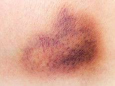 Los síntomas de la hemofilia incluyen: moretones que no siguen un patrón habitual en localización ni cantidad; repetidas hemorragias nasales que son muy difíciles de controlar; sangrado excesivo al morderse el labio, al perder un diente o en las extracciones dentales; articulaciones dolorosas o inflamadas y sangre en la orina.