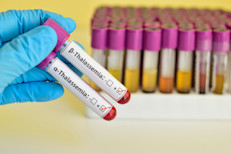 Existen dos tipos principales: la talasemia alfa y la beta. Se calcula que la talasemia beta afecta a unas 1,000 personas en Estados Unidos. según informan los CDC. A veces se conocen por otros nombres, como Constant Spring, Anemia de Cooley, o Hemoglobina Bart. Estos son específicos de ciertas talasemias, por ejemplo, la anemia de Cooley es lo mismo que la talasemia beta mayor. El tratamiento consiste en realizar transfusiones de sangre.