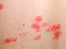 Shingles (herpes zoster) is a skin rash caused by a virus in the herpes virus family. The virus that causes shingles (herpes zoster) is the same virus that causes chickenpox. Some of the symptoms include constant pain, general discomfort, headache, and joint pain. There is a vaccine against this type of herpes that is especially recommended for adults and seniors. 