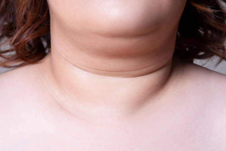La papada puede causar vergüenza, pero no hace falta esconderse tras una bufanda para ocultarla. Existen alimentos y ejercicios que se asocian a su prevención e incluso reducción. Esto se debe a que mejoran la tonicidad muscular, flexibilizan los músculos de la zona y reducen el volumen para volver a tener un rostro joven. 