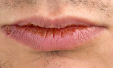 Los labios agrietados pueden hacer que la piel que los recubre se rompa, sangre y se pele.  A veces son una señal indiscutible de  enfermedades o condiciones subyacentes como deshidratación, deficiencia de vitaminas o problemas más graves, si son muy persistentes y no responden a los remedios caseros. Si el ungüento no ayuda, consulta con tu médico ya que puedes tener una condición más seria.