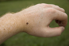Es importante eliminar estos parásitos porque pueden causarte afecciones como la fiebre por garrapatas de Colorado, la enfermedad de Lyme y tularemia. Rociar la ropa con un químico llamado permetrina puede detenerlas y prevenir sus picaduras.