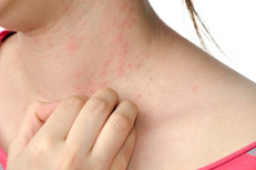 Cualquier persona puede padecer psoriasis, aunque ocurre con mayor frecuencia entre los adultos. En algunos casos, las personas con esta condición tienen antecedentes familiares. Ciertos genes parecen estar vinculados a la enfermedad, que afecta de igual manera a hombres y mujeres. 