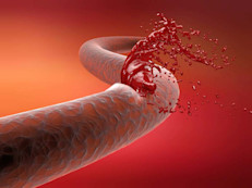 La hemofilia es una afección hemorrágica hereditaria que hace que la sangre no coagule de manera adecuada. Las personas con esta afección presentan un defecto en uno de los genes que le indican al cuerpo que produzca las proteínas necesarias para la coagulación normal de la sangre. Por portar ese gen defectuoso, podrían sufrir de un sangrado prolongado a causa de una lesión, y hasta el riesgo de una hemorragia interna.  