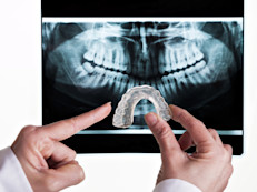 El odontólogo puede indicar el uso de protectores bucales (imagen arriba) para mantener los dientes separados, en especial durante la noche.  Pueden ser de acrílico duro o de materiales suaves como la silicona. Algunos toman sólo los dientes de arriba, otros los de abajo y algunos únicamente las muelas.