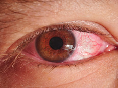 Las gotas lubricantes sin conservantes se pueden las veces que sea necesario. Si las que usas contienen conservantes, los especialistas de la Clínica Mayo explican que no se deben aplicar más de cuatro veces al día. 