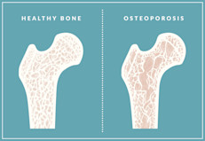 Otros minerales que se destacan en el baobab son el calcio y magnesio, ambos importantes para fortalecer la masa ósea y prevenir enfermedades de los huesos como la osteoporosis. Aunque la evidencia científica es insuficiente para corroborar sus efectos, los expertos aseguran que no es malo tener presente el baobab en la dieta, especialmente a medida se envejece. 