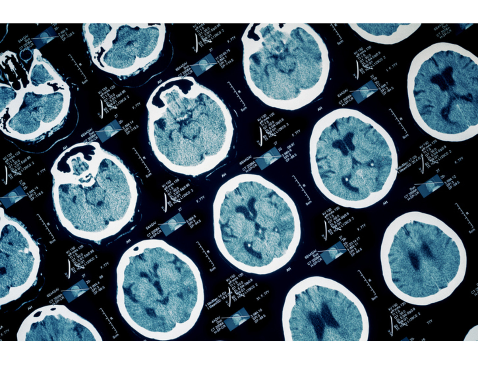 La epilepsia es un trastorno neurológico que afecta a más de 50 millones de personas en el mundo, y aproximadamente 3 millones en EE.UU. Sin embargo, especialistas advierten que hasta el 70% de las personas que la padecen pueden vivir sin convulsiones si recibieran un diagnóstico a tiempo y un tratamiento adecuado. Conoce aquí sus síntomas, causas y tratamientos.