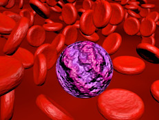Es el cáncer de la sangre más común y comprende 4 tipos: leucemia linfocítica aguda, leucemia linfocítica crónica, leucemia mielógena aguda y leucemia mielógena crónica. Aunque afecta más a menudo a los adultos que a los niños, la leucemia se encuentra entre los cánceres infantiles más comunes, y la llamada linfocítica aguda representa el 75% de los casos de leucemia infantil, según el Instituto Nacional del Cáncer (NIH). 
