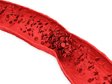 El coágulo de sangre puede desprenderse y viajar a través del torrente sanguíneo y depositarse en una arteria en los pulmones, bloqueando el flujo sanguíneo. Esta afección se llama embolia pulmonar (PE, por sus siglas en inglés) y es una afección muy grave. Puede dañar los pulmones y otros órganos y hasta causar la muerte. 