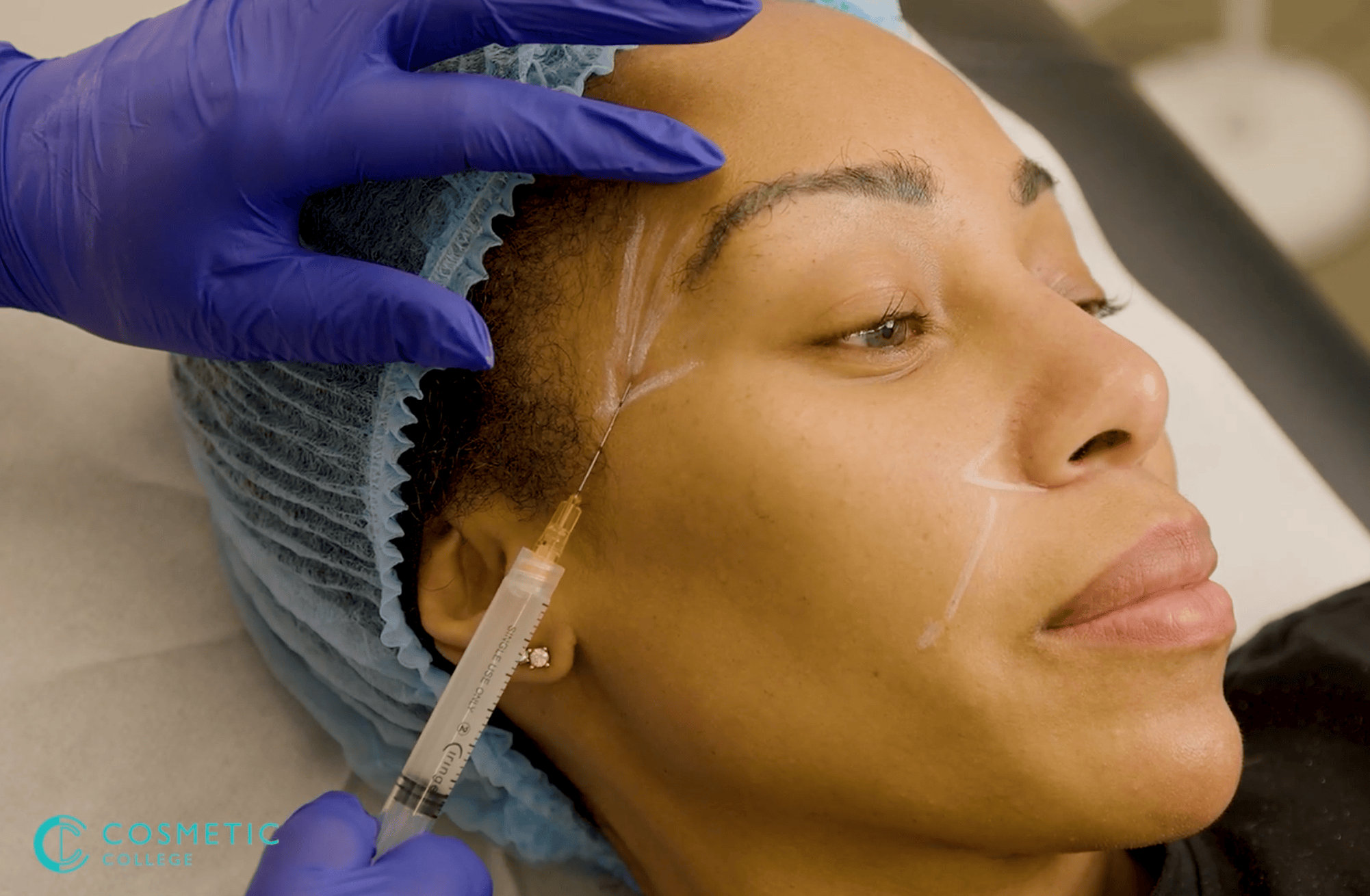 Bio Stimulator Sculptra & Aesplla