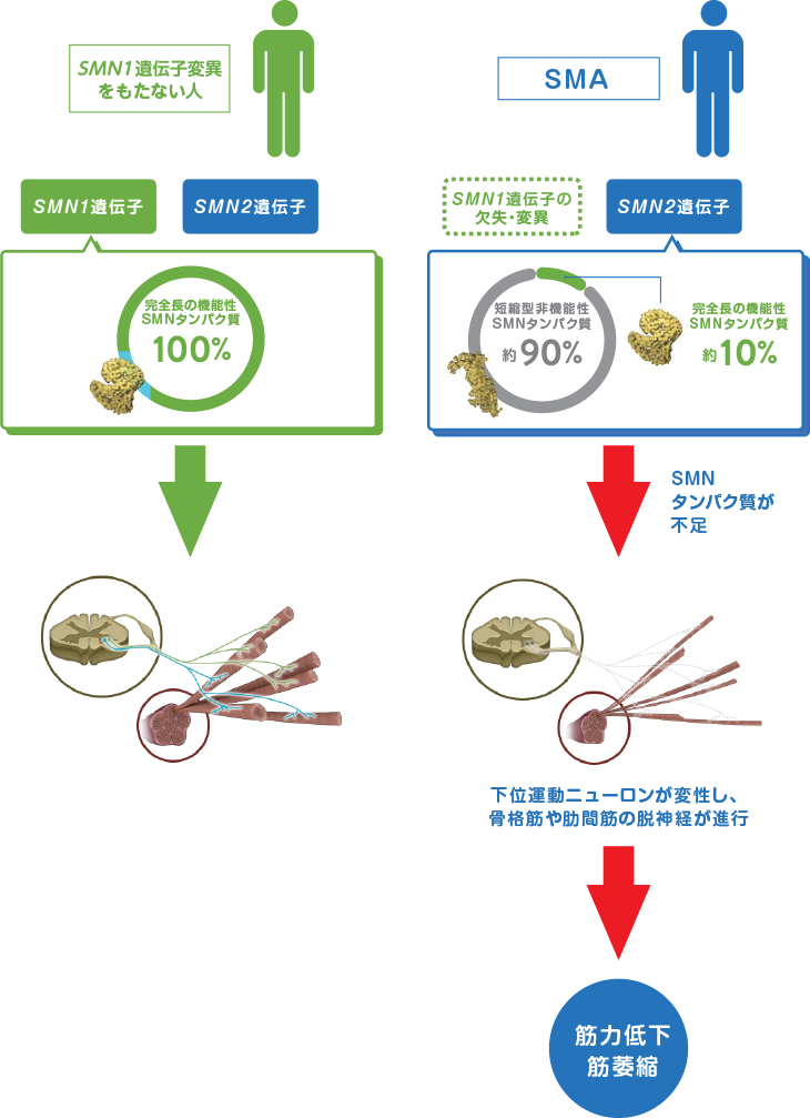 SMAの原因・診断｜SMAについて知る｜診断サポート｜脊髄性筋萎縮症(SMA)｜BiogenLinc｜バイオジェン