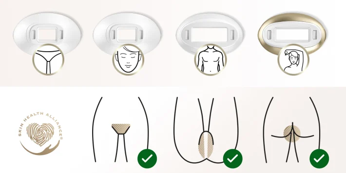 Utilisation de l’IPL dans la zone pubienne