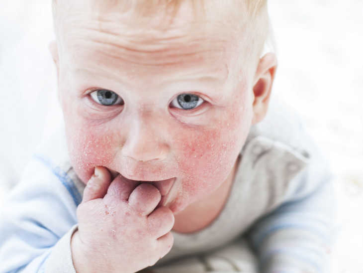 Baby mit Neurodermitis im Gesicht