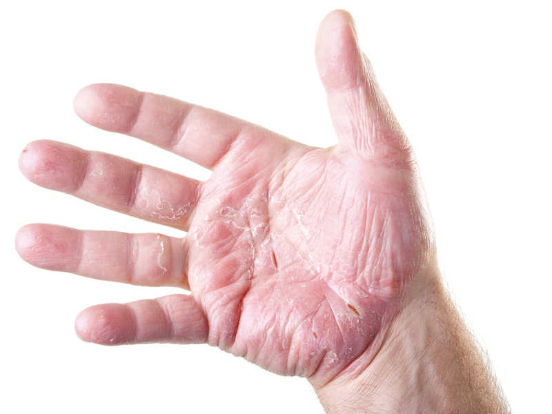 Hände mit Neurodermitis