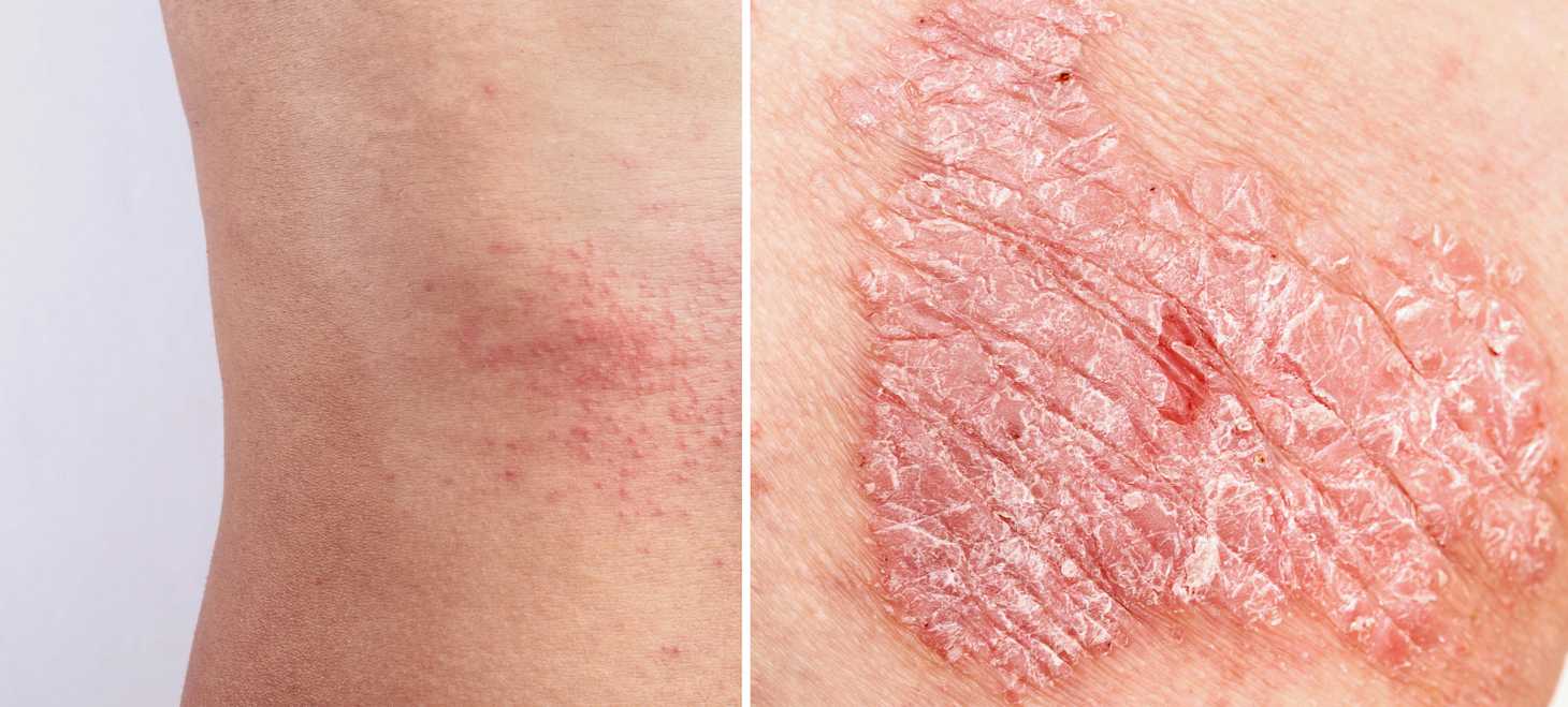 Neurodermitis und Schuppenflechte | Hautstark