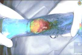 Il verde: un nuovo alleato nella chirurgia dei sarcomi dei tessuti molli