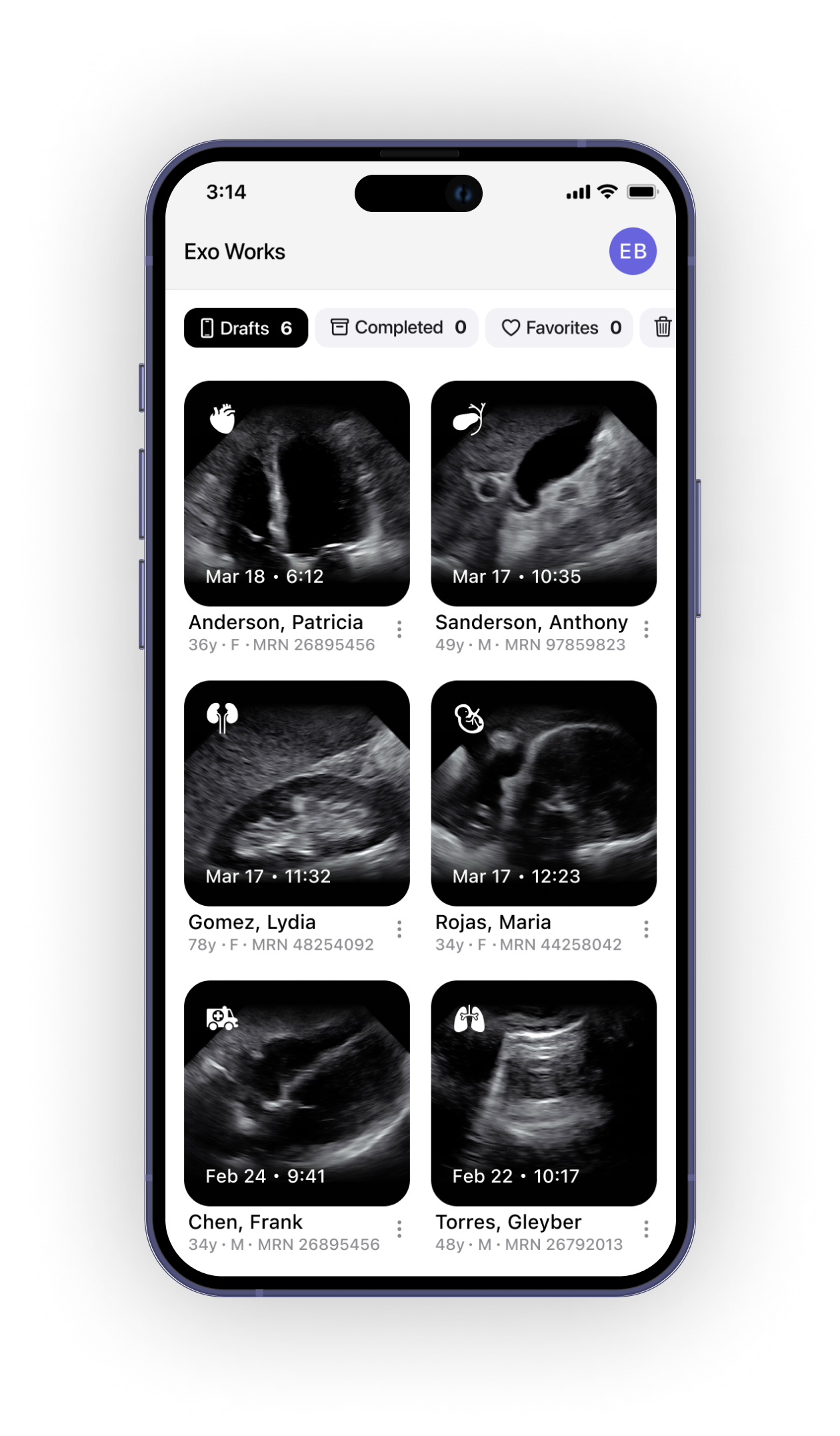 Phone running the Exo app displaying an ultrasound