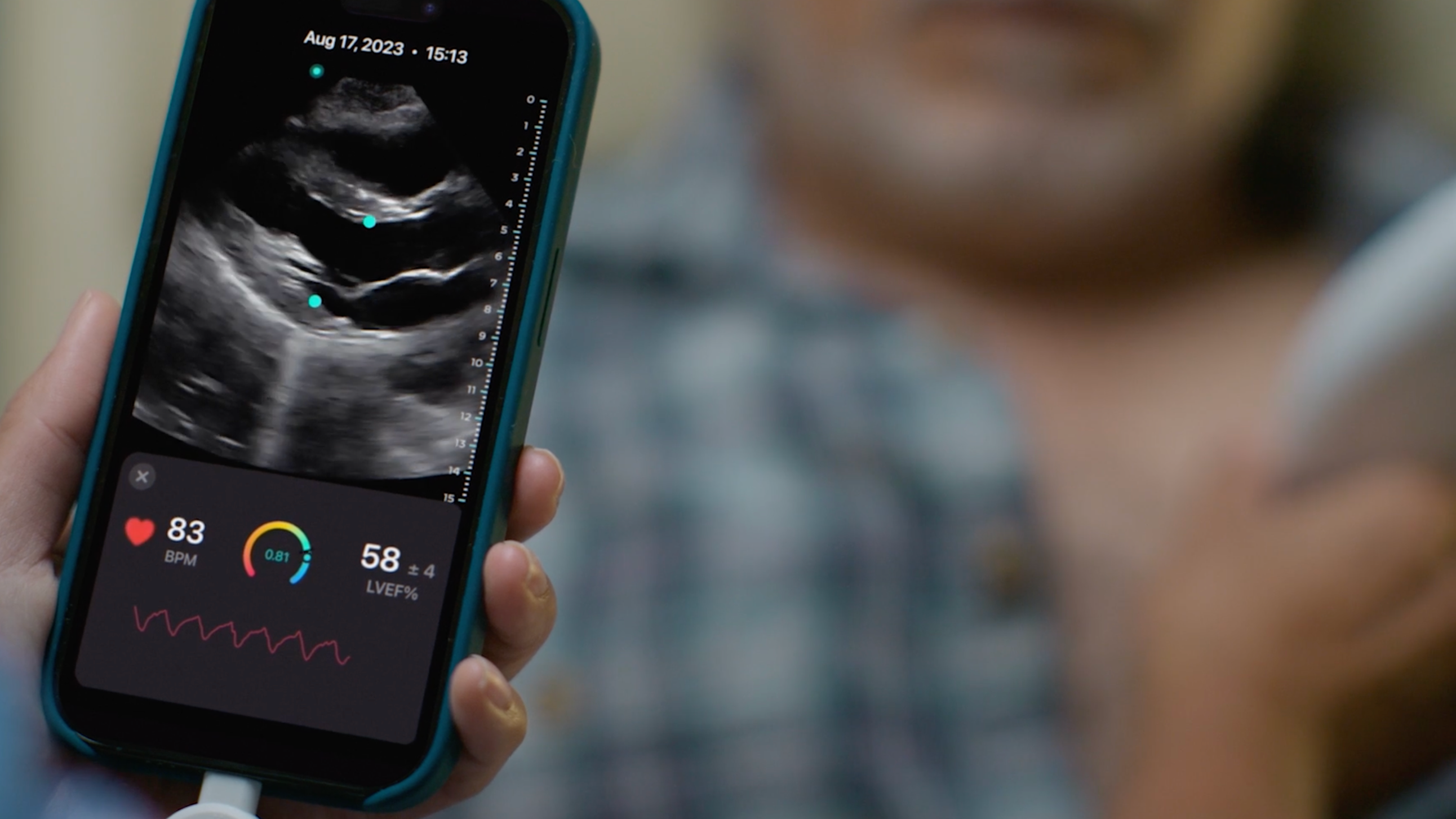 Exo Iris is the new age of ultrasound, a handheld device unlike any other. 