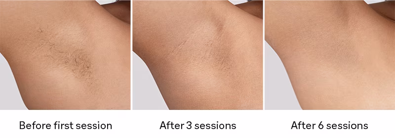 Three images of the underarm comparing hair growth before using Braun Silk&middot;expert Pro 5 and after 3 and 6 sessions. מסיר שיער Silk expert Pro 5&nbsp;PL5412 IPL - עם 5 שנות אחריות יבואן רשמי&nbsp;מבית BRAUN