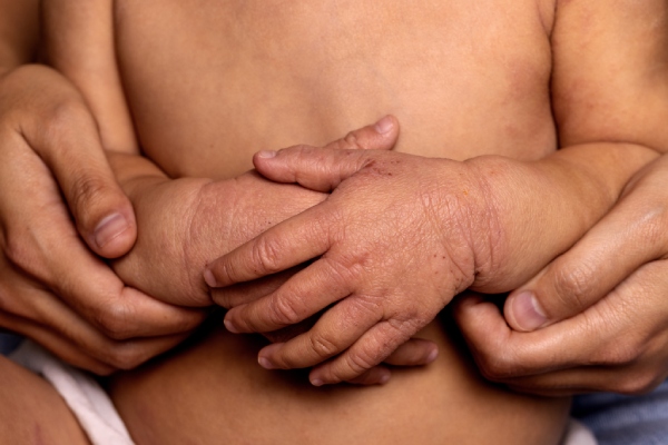 A baby’s upper body and hands with eczema