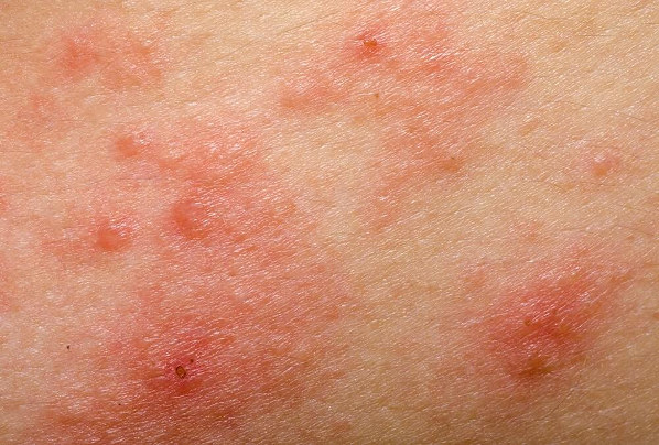 Une image d’une peau avec des plaques rouges montrant des signes d’eczéma