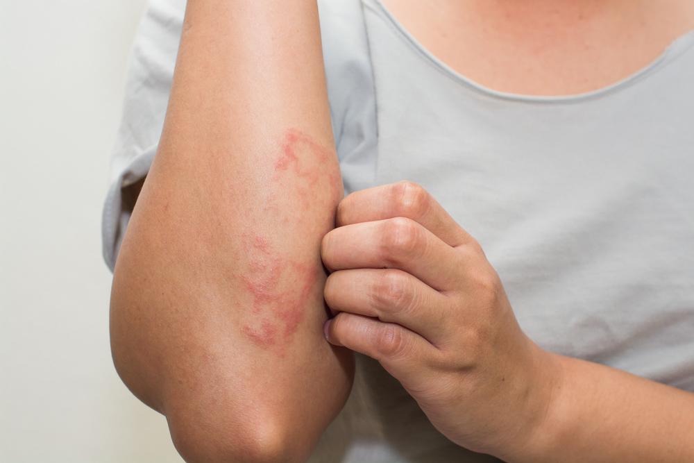 A person itching their arm with red patches due to eczema